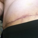 12 Weeks PO - TT scar, left side