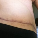 12 Weeks PO - TT scar, right side