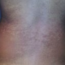 Before Treatment: This is my Lower Back. You can clearly see the clustered white patches.  My natural skin color is the brown pigment.