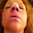 Day 1--few hours post-op
