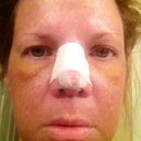 Day 5--most lower jaw swelling