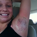 05/30/12 --- This is right after I got the procedure done, and I was being driven home. Clearly you can tell how excited I was! (The black is Sharpie marks, and the template tattoo to help the doctors)