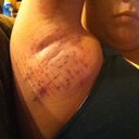 05/30/12 --- This is the same day I got the procedure done, probably 7-8 hours later. There was quite a bit of swelling, but absolutely no pain. Just an uncomfortable feeling since you're not used to your armpits being swollen! ---- ICE ICE ICE those pits!