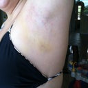 06/03/12--- My left arm 4 days later. The bruises are fading, and the swelling has gone down A LOT! (Because of the constant icing!) The 'uncomfortable' feelings have subsided. All feels normal!