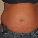 Pre Surgery-Front