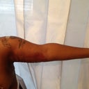 Arms 3 day postOp...My back looks like a train track but all is well. I am satisfied!