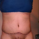 Still bruised on the sides from the lipo and swelling has gone down a bit (juicing & drinking cucumbers + water).
Post Op day 14
