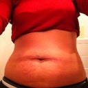 Pre-op