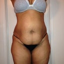 Before the tummy tuck...