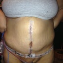 Front view 2 days after surgery.