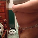 Side view 2 days after surgery.