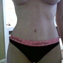 3 weeks post op. You can see the swelling in the middle.