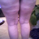 My 'treatment stripes' I had every week for 3 months. HOT and PAINFUL!!!