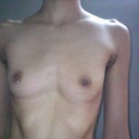 2 weeks post breast implant removal