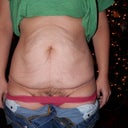 You can see the upper sag from the pregnancy!