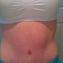 6 weeks post op