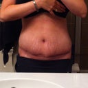 3 week po at the end of the day. PS calls the area from bb down to incision the "Flap". He says that I could expect swelling below the Flap from now to possibly off and on 3-6 months.. I am getting a smaller garment next week to press in more. So we'll see if it helps the "Flap" area :)