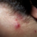 Sore pimples along the edge of the hairline where the laser went from behind the ear down the neck.
