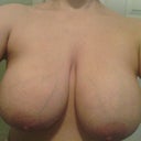 Before breast reduction D40
