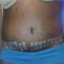 7 days Post-op. Still somewhat swollen.
