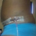 7 days Post-op. Side view. Drains still in :-(