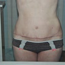 One year from original TT, 8 weeks from revision. No more vertical!