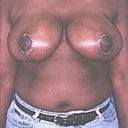Female Breast Reduction