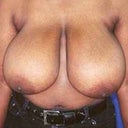 Female Breast Reduction