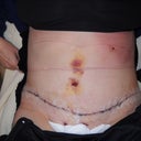 Post op Day 3