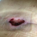 What I'm dealing with 6 weeks PO. seroma