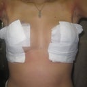 first look so happy. post op day 4