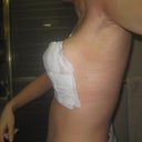 left side post op day 4