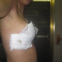 right side post op day 4, a little leakage/bleeding but nothing to worry about