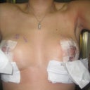 Nip Slip!! post op day 4