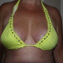 7 weeks post-op....New bikini woohoo!!!