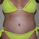 7 weeks post-op