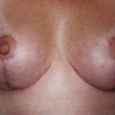 7 weeks post-op...Still need more healing under each breast.