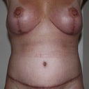7 weeks post-op...My scars are not too bad.