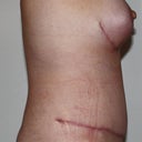 7 weeks post-op side view...you can see that I'm still swollen.