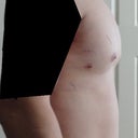 9 days post op