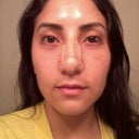 8 days after surgery you can tell that the right eye (your left) has a dent in the inner corner of my lower lid compared to the left eye (your right)