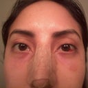 10 days after surgery, here's a better view of the dent I had on one of my lower lid that I disliked very much
