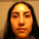 4 weeks after surgery my lower lids have come a long way, and Im pretty please with how much they've improved and will still continue to