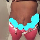 sorry ladies but I have alot of tattoos lol my tummy has indentation I believe from the garment I wore after my tummy tuck, I hate it. it will be make 1 year this december after I had my tummy tuck and till this day I have few sensation in my tummy. salama said he would smoothen it out for me. I had alot of stretch marks and usually stretch marks at the top of the belly would stil be noticeable after tummy tuck.