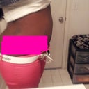 1 day post op very very swollen
