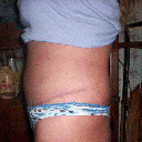 11-22-11 3 weeks post op ~ still really swollen