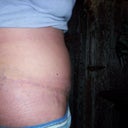 11-22-11 3 weeks post op ~ still really swollen ~ close-up of incision/scar ... I'm so happy with results