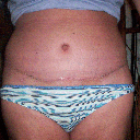 11-22-11 3 weeks post op ~ still really swollen ~ looks GREAT! Really dry, but I'm not allowed to put anything on the incision for another 2 weeks :(