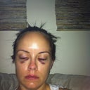 I think the flash makes the bruising look worse (about 6 hours after surgery).