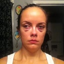 The bruising's bad but not as bad as the flash made it look (about 6 hours after surgery - the bruising came on really fast!  And what lovely, swollen eyes!).